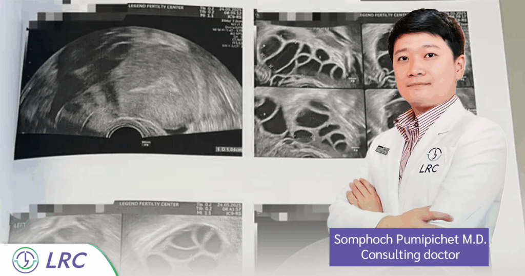 Successful ICSI case review for PCOS patients! Ms. H, 33, with 86% blastocyst rate at LRC. Learn fertility success tips here.